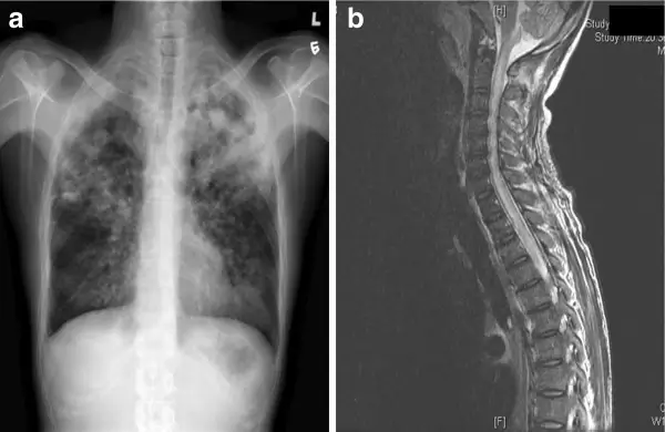 The Rise of CBD in the UK During Lockdown 2 Xray of Lungs and Spinal Cord
